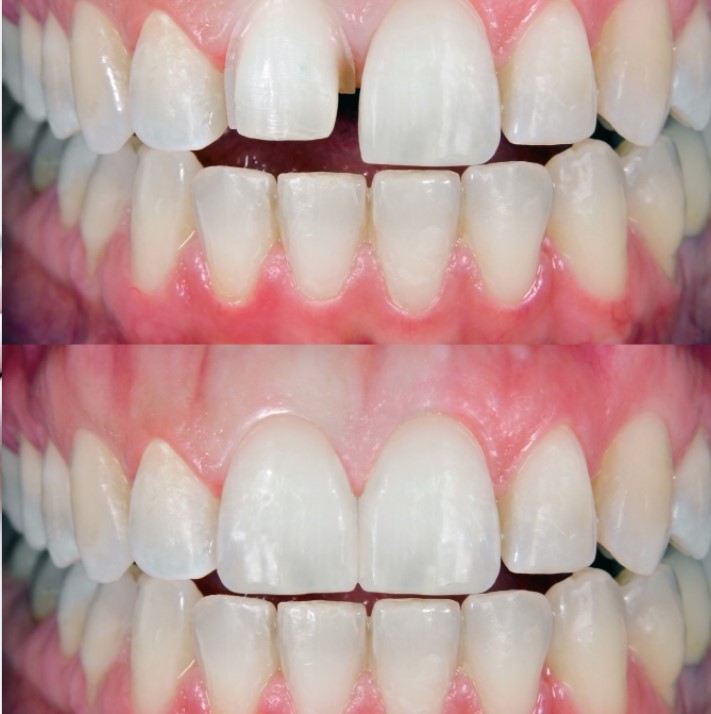 Changes You Can Notice After Using Dental Veneers