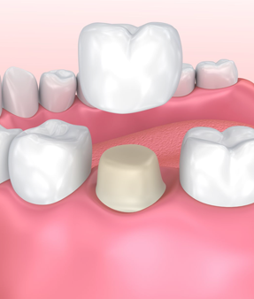 Treatment - Natural Smiles Implant & Cosmetic Dentistry