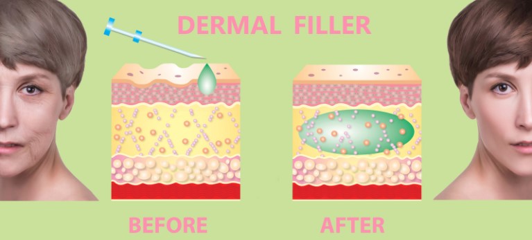 Dermal Fillers before after