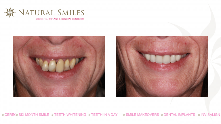 Smile Design in Leicester and Corby