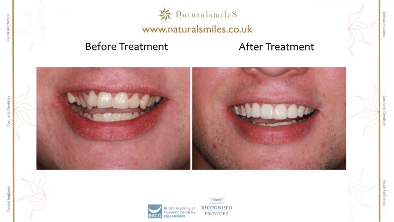 Six Months Smiles and composite veneers