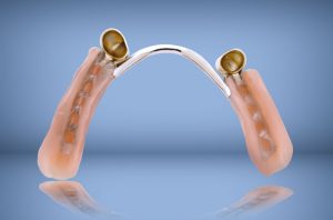 Telescopic dentures at Corby Dentist