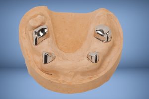 Telescopic dentures at upper full denture