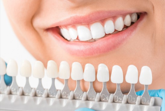 Tooth Whitening results