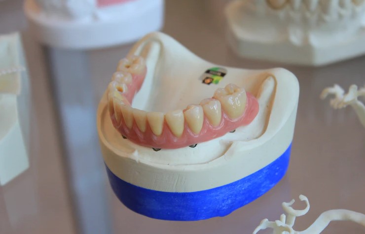 benefits of dental veneers