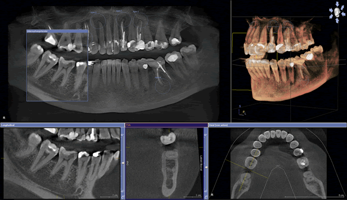 CT scan for Dental Implants