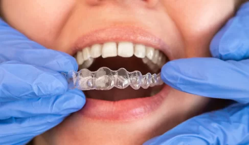 What is an Inman Aligner