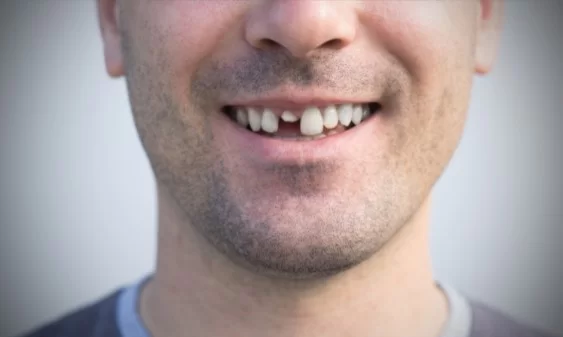 Tooth implants to fix broken teeth