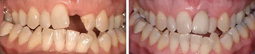 Tooth Implant before after
