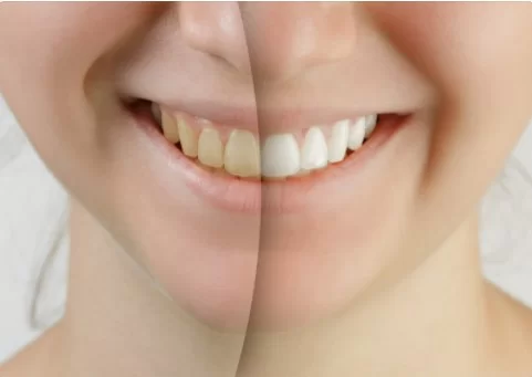 cost of Enlighten teeth whitening