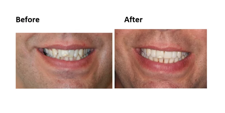 before and after invisalign