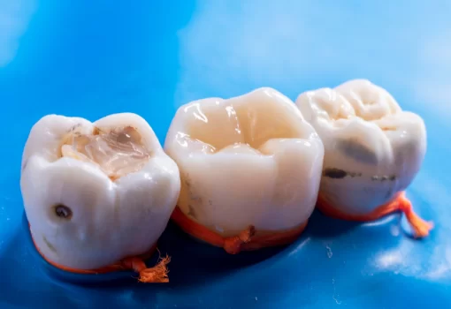 What are the different types of fillings