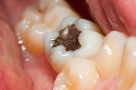 Caring for your white fillings