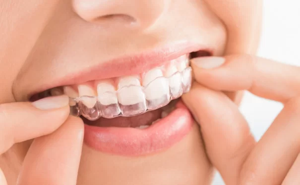 How long does Invisalign take to fix crooked teeth