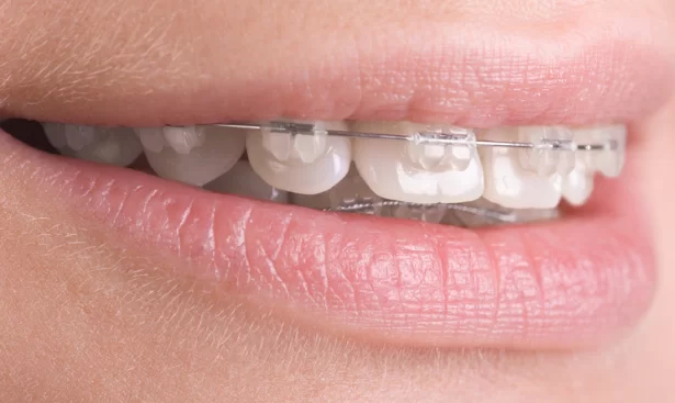 What is the Process of installing clear braces