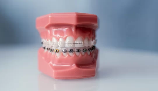 What are Cfast braces