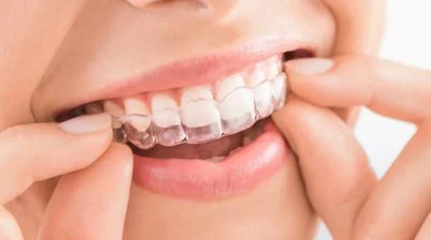 Difference Between Cfast and Invisalign