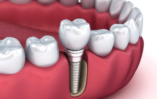 What are Tooth Implants