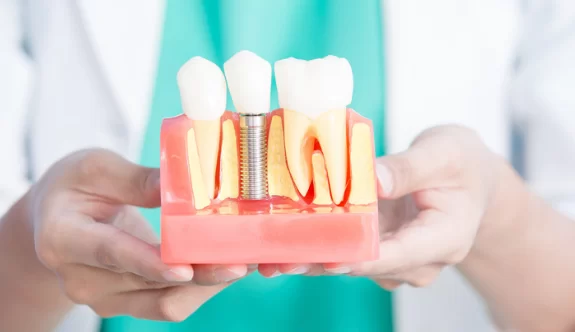 Cost of a Single Tooth Implant in the UK