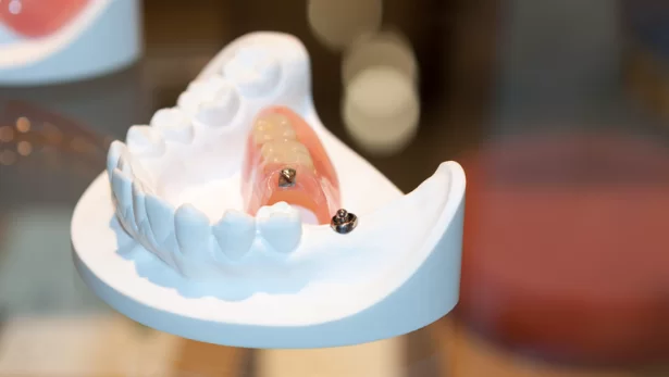 Benefits of Teeth Bonding