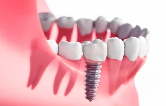 What are the Downsides of Implant Supported Dentures