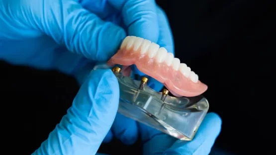 Advantages of Implants over Dentures