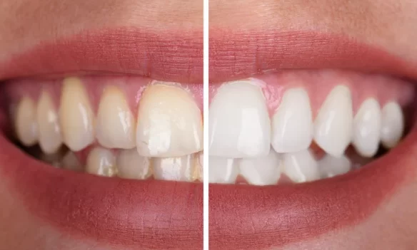 What actually makes your Teeth Whiter