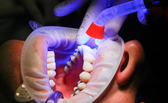 Ceramic Filling Charge Depends on the Dental Clinic