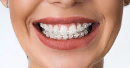 What are Dental Braces