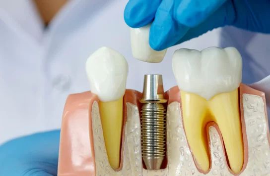 What is a Dental Implant Made of