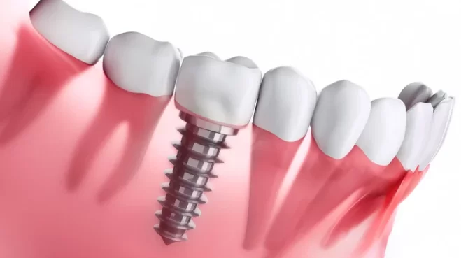 Factors that Reduce Longevity of Dental Implants