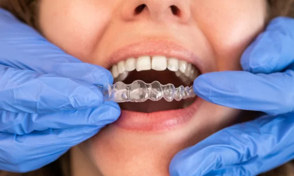 Why Should You Get An Invisalign