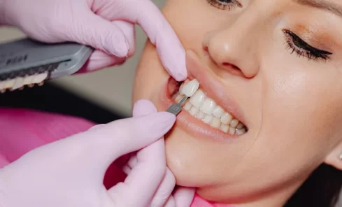 Tips to take care of your Veneers