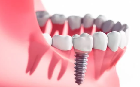 Bone graft for dental implants - The procedure