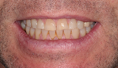 Before - Natural Smiles Implant & Cosmetic Dentistry