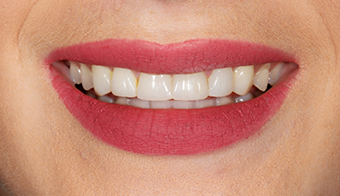 After - Natural Smiles Implant & Cosmetic Dentistry