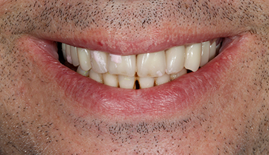 Before - Natural Smiles Implant & Cosmetic Dentistry