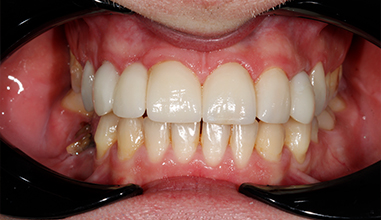 After - Natural Smiles Implant & Cosmetic Dentistry