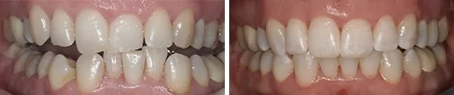 Inman aligner before and after