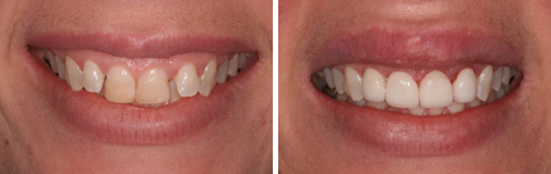 Invisalign i7 - before and after