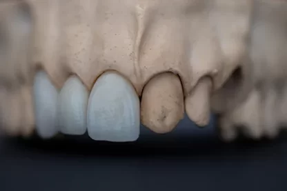 See-through Teeth