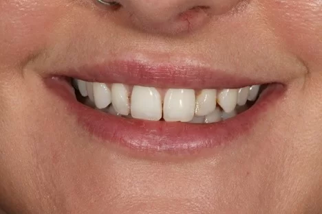 Teeth Bonding Cost In Uk