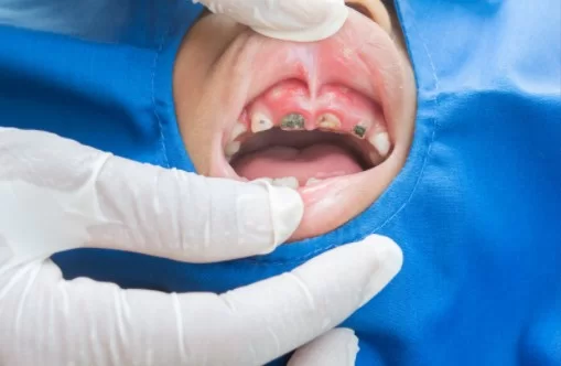 What Is Denture Stomatitis
