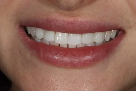 What Is Teeth Bonding