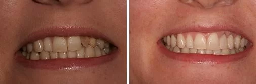 dental bonding before and after